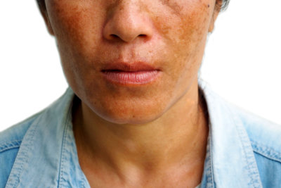 woman with skin disease