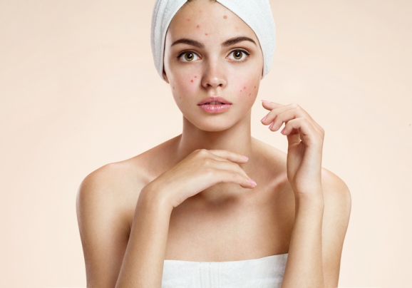 5 Myths About Acne You Need to Stop Believing 